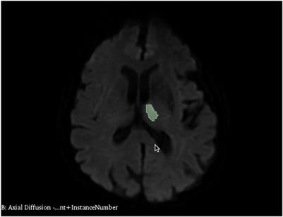 Association between left atrial volume index and infarct volume in patients with ischemic stroke